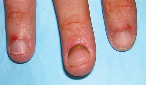 paronychia finger infection orders  wwwpinnaxiscom
