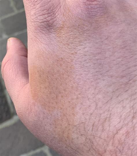 Brown/Orange 'stains' on hands in the morning. : r/medical