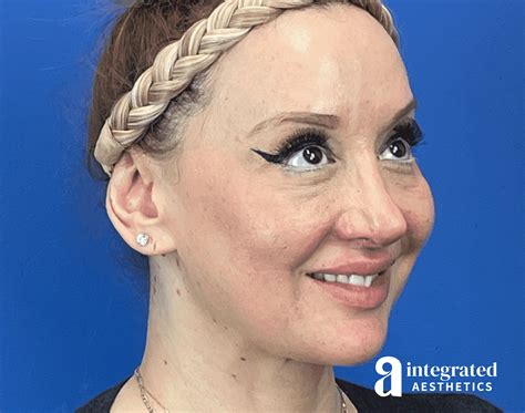 chemical face peel before and after 8