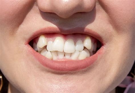 straighten  crooked tooth tips  options
