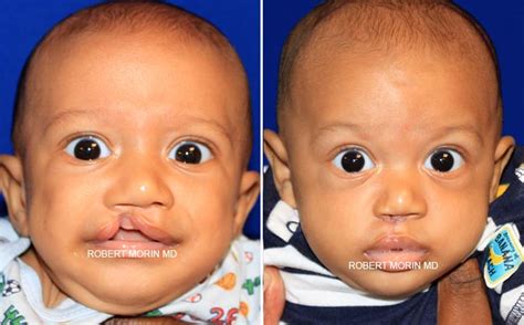 Cleft Lip And Palate Nose Surgery - Infoupdate.org