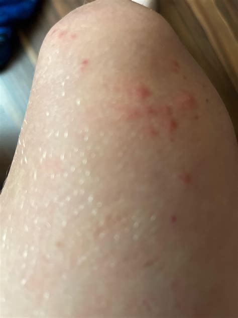 Red spots on knee : r/DermatologyQuestions