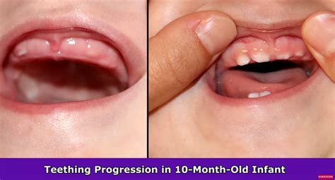 teething gums     months infoupdateorg