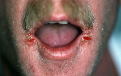 Causes of Angular Cheilitis - MEDizzy