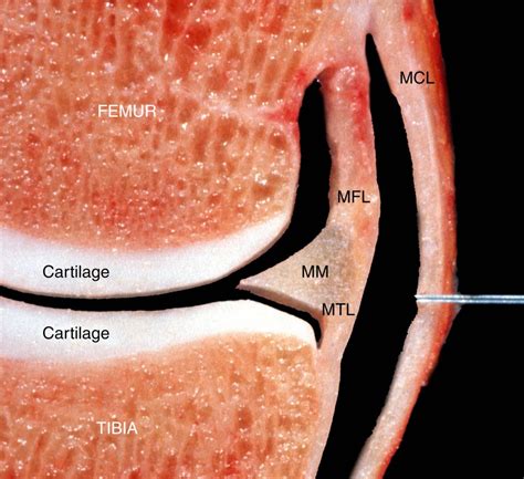 meniscal pathology meniscus anatomy musculoskeletal key