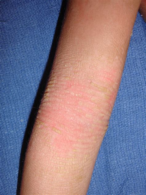 Pathology Outlines - Epidermolytic hyperkeratosis