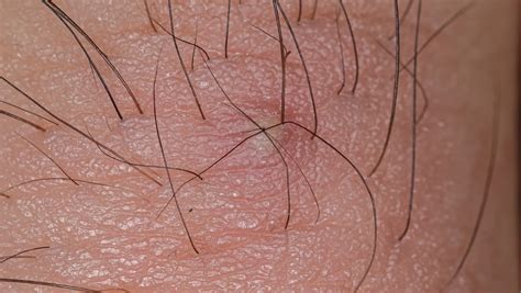 ingrown hair  penis  treatment std differences