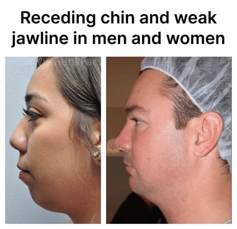 overbite  weak chin