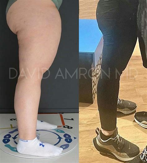 Albums 104+ Pictures Liposuction For Lipedema Before And After Pictures ...