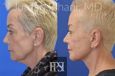 facelift facial plastic surgery institute