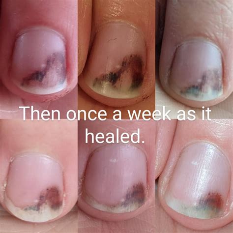 Healing of a bruised finger : r/MedicalGore