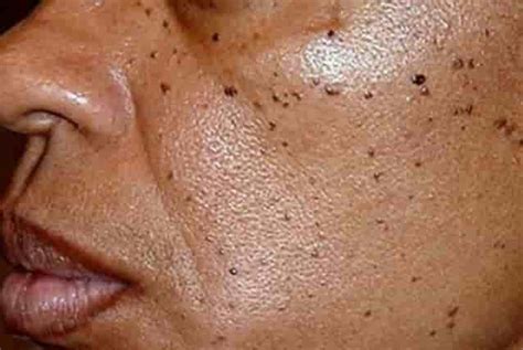 dark spots  skin vrogueco