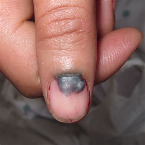 Fig. 5.10 Subungual hematoma from trauma. – DermAlive