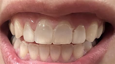 Anterior teeth turning grey : r/askdentists