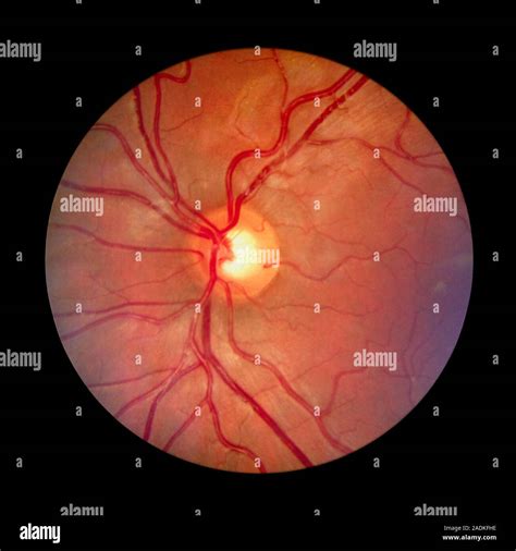fundus camera image   retina   normal eye showing