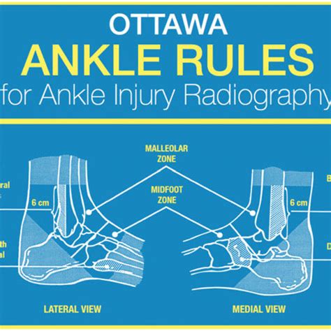 Ottawa ankle rules: Criteria for X-ray series requirements. | Download Scientific Diagram