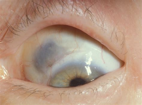 Moran CORE | Scleritis