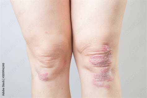 Acute psoriasis on the knees is an autoimmune incurable dermatological ...