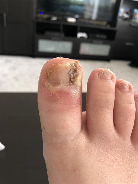 Partial toenail Avulsion recovery : r/Ingrown_Toenails