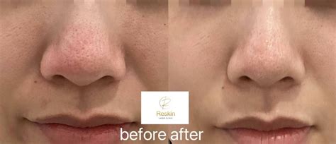 STELLAR M22 IPL – Reskin Laser Clinic