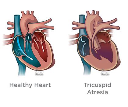 hypoplastic  heart syndrome hrhs diagnosis treatment ssm health