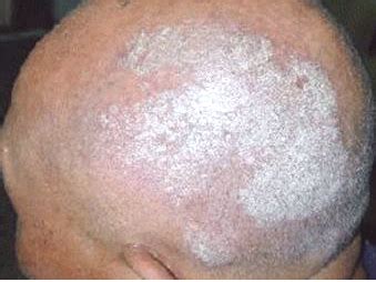 Scalp psoriasis - pictures, treatment, symptoms, causes