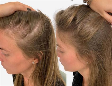 hair loss  women female hair loss treatment birmingham