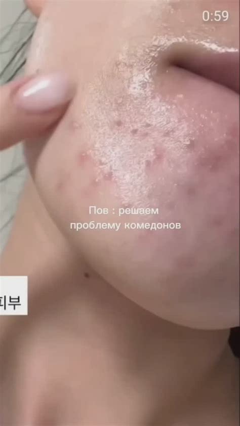 Вика | БЬЮТИ МАТЬ | Давайте с самого начала: Черные точки на носу (так ...