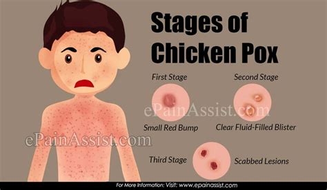 early stages  chickenpox images