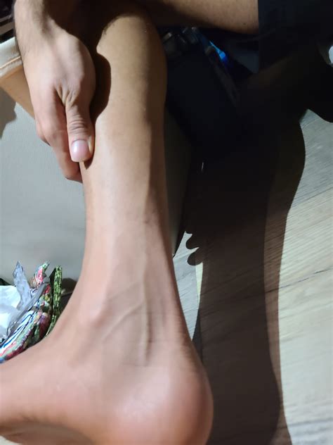 Bulging veins reactions : r/dysautonomia