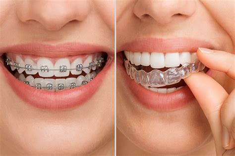 invisalign  braces      hansen ortho