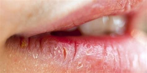 Labios Ressecados E Rachados O Que Pode Ser - Lábios rachados? Veja como podemos prevenir esse incomodo no inverno