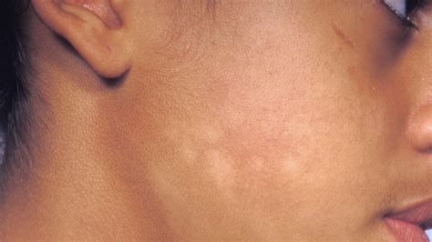 How to Tell if It’s Vitiligo or Something Else
