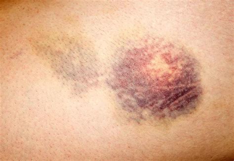 unexplained bruising cut scrape  bruise colorado kids pediatrics