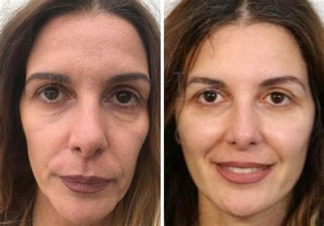 ideal age   facelift comprehensive expert insights
