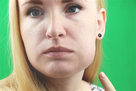 face cheek swelling     melbourne dentist  malvern east