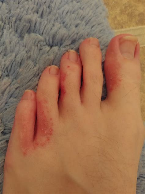 Foot Fungus Vs Eczema at Stephanie Quick blog