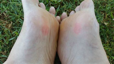 Blister Healing Time: How Long Does It Take For A Blister To Heal ...