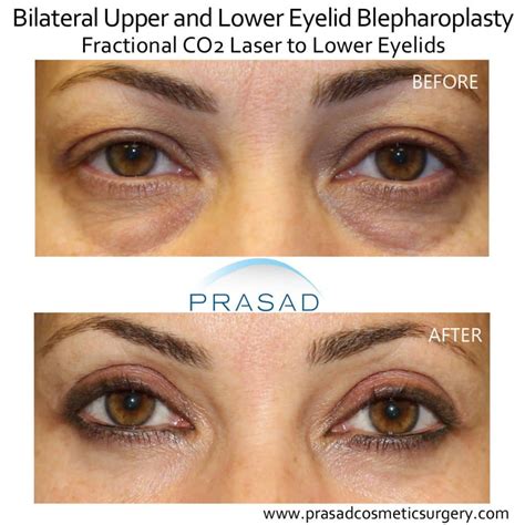 laser treatment  dark circles  eyes dr prasad blog
