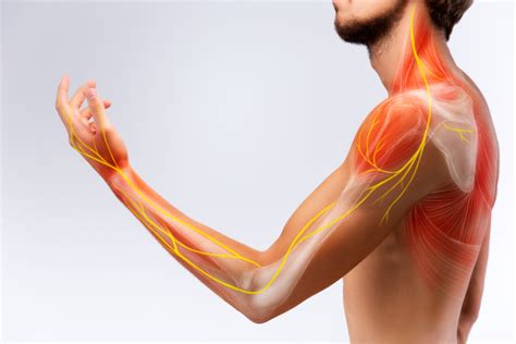 Cervical Radiculopathy: Causes, Symptoms & Treatment - Paresthesia