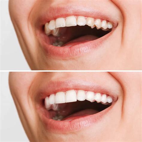 tooth crown cost with insurance 6