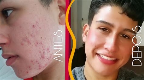 Vitacid Xt Antes E Depois Rugas - Usei o Vitacid Xt 1% (Tretinoina 1mg) - Cleiton Afonso - YouTube