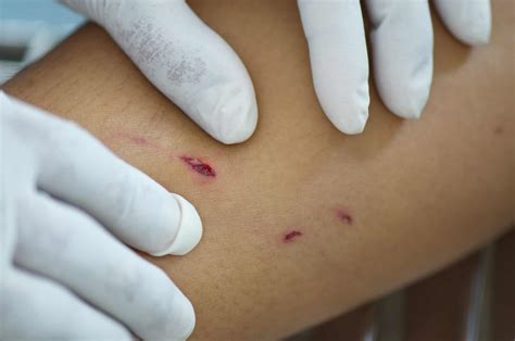 doctor  dog bite