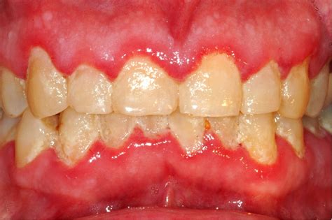 What is gingivitis? Explained here. - DIVINE DENTAL CARE