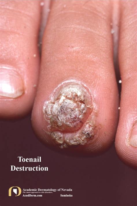 Plantar Warts (Verruca Plantaris): Seed Warts? - Academic Dermatology of Nevada