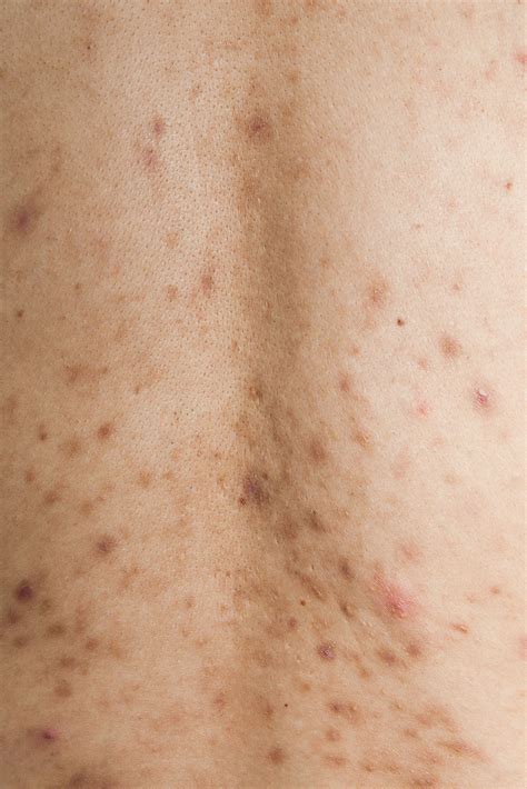 Post-Inflammatory Hyperpigmentation and Acne