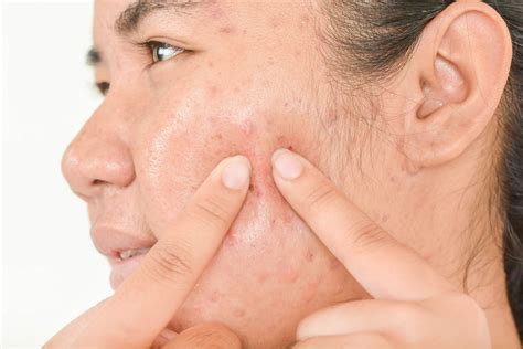 3 Natural Treatments for Cystic Acne | Cystic Acne Remedies