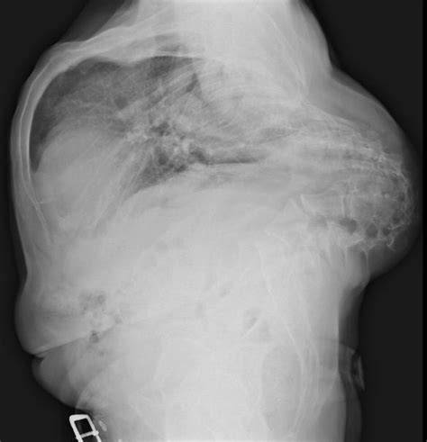 Kyphosis chest x ray - wikidoc