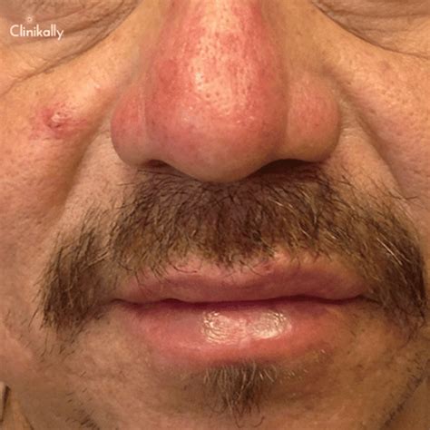 rhinophyma nose swelling   treatment options clinikally