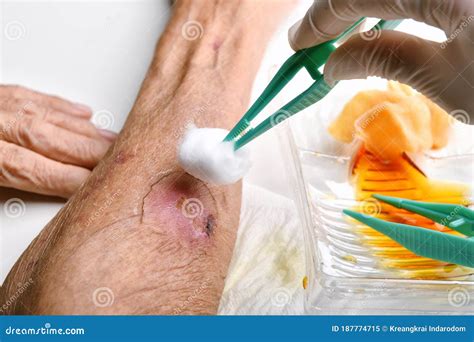 Chronic Wound Royalty-Free Stock Photography | CartoonDealer.com #70305881